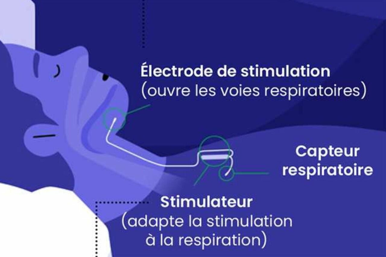 En France, un implant cérébral contre l'apnée du sommeil pourrait ...