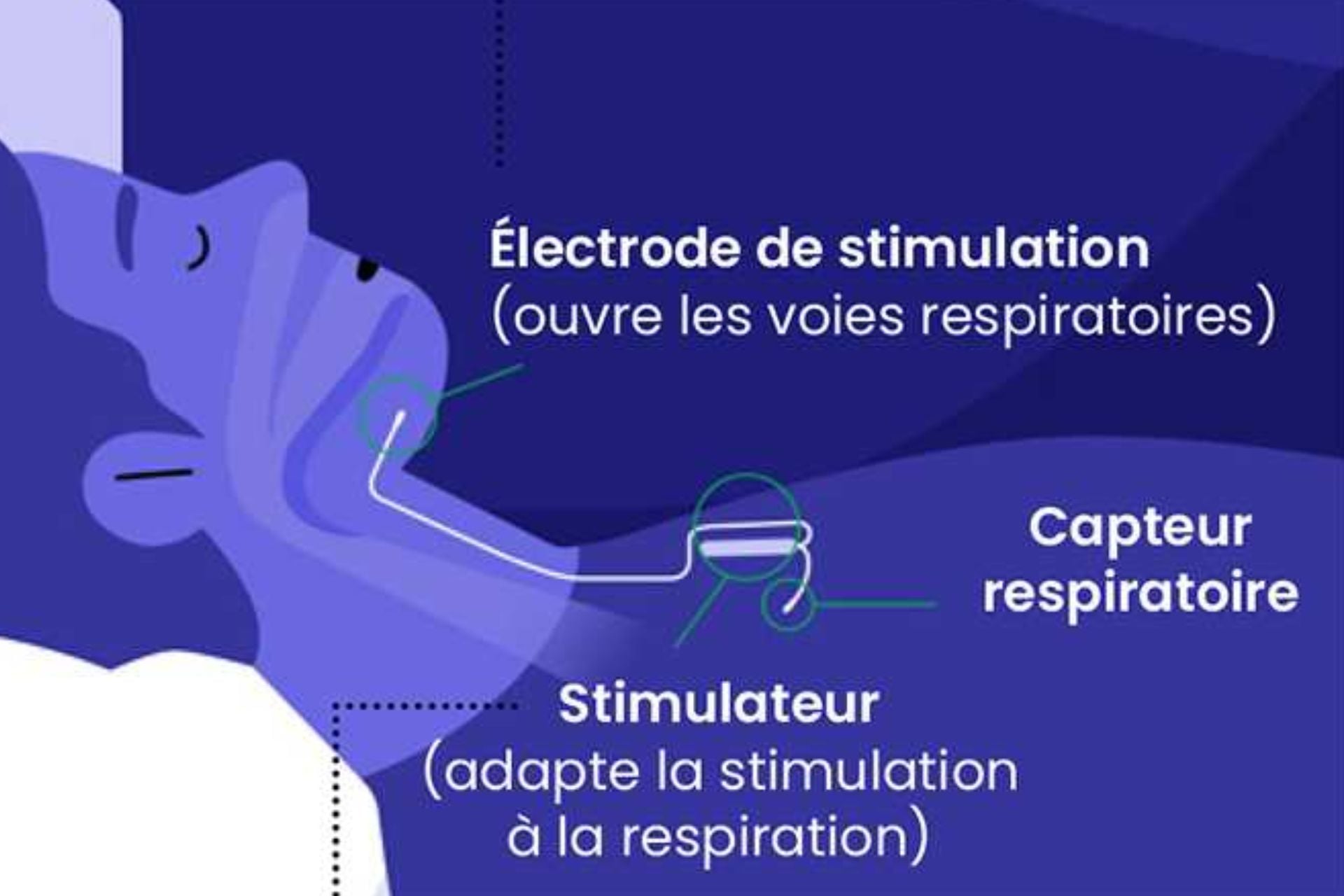Apnée Sommeil (1)