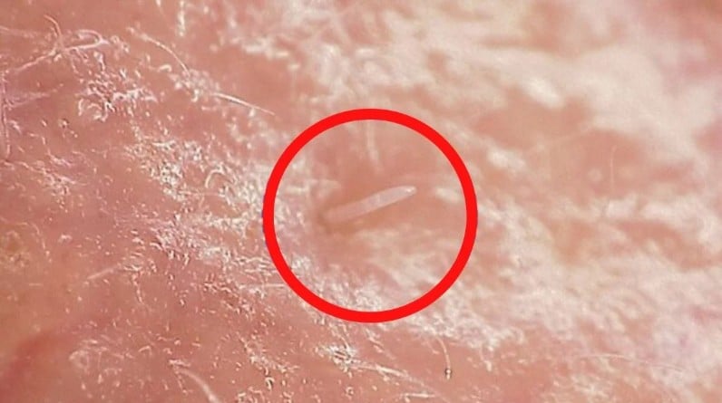 Demodex Folliculorum